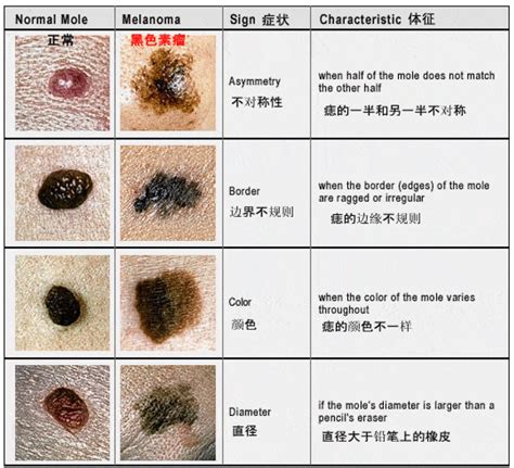 身上黑痣增多|痣也可能会癌变！长在 3 个地方要注意